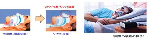 持続陽圧呼吸法